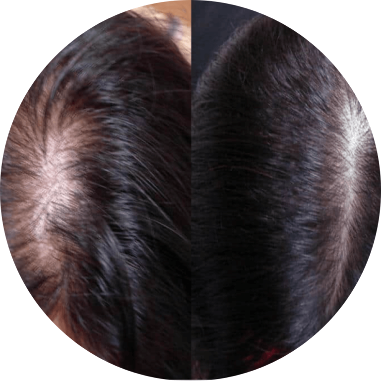 É um procedimnto indicado para homens e mulheres, que sofrem com a queda de cabelo constante, devido a diversos fatores, como estresse, deficiências nutricionais e os fatores genéticos, como no caso da alopecia, conhecida como a calvície.